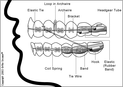 braces-diagram